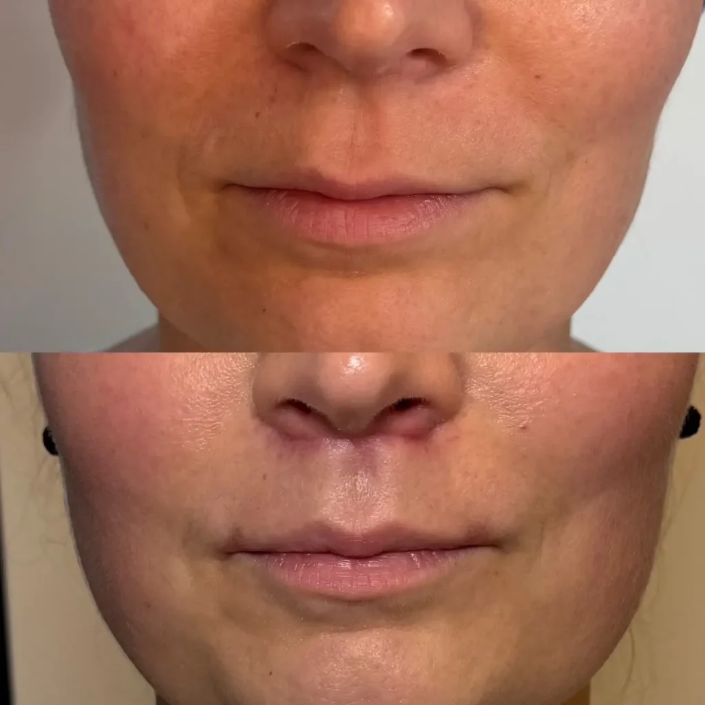 Lip lift i corner lip lift – sekret perfekcyjnie wymodelowanych ust, bez przesadnego wypełnienia
